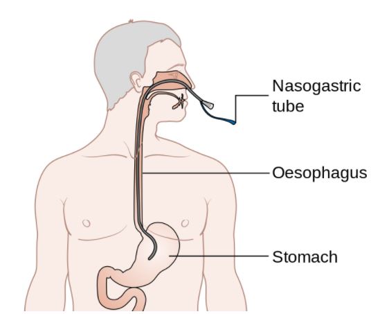 TUBE, GASTRIC, conical tip, 125 cm, s.u., CH18