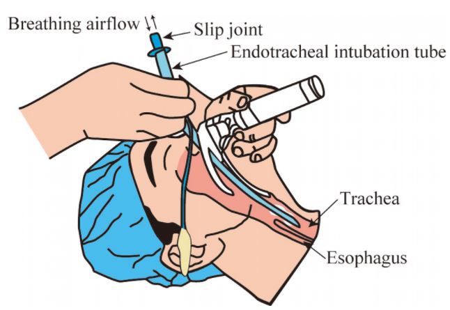 TUBE, ENDOTRACHEAL, s.u. + CONN., balloon, Ø 5 mm