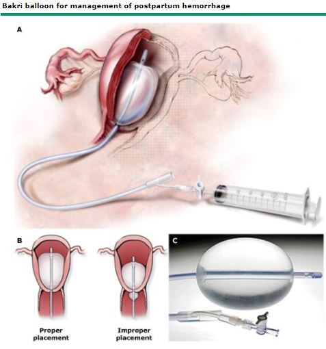 BALLOON + CATHETER, POST-PARTUM HAEMORRHAGE, 500 ml