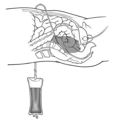 PERITONEAL DIAGNOSTIC LAVAGE SET, ster. s.u.