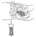 PERITONEAL DIAGNOSTIC LAVAGE SET, ster. s.u.