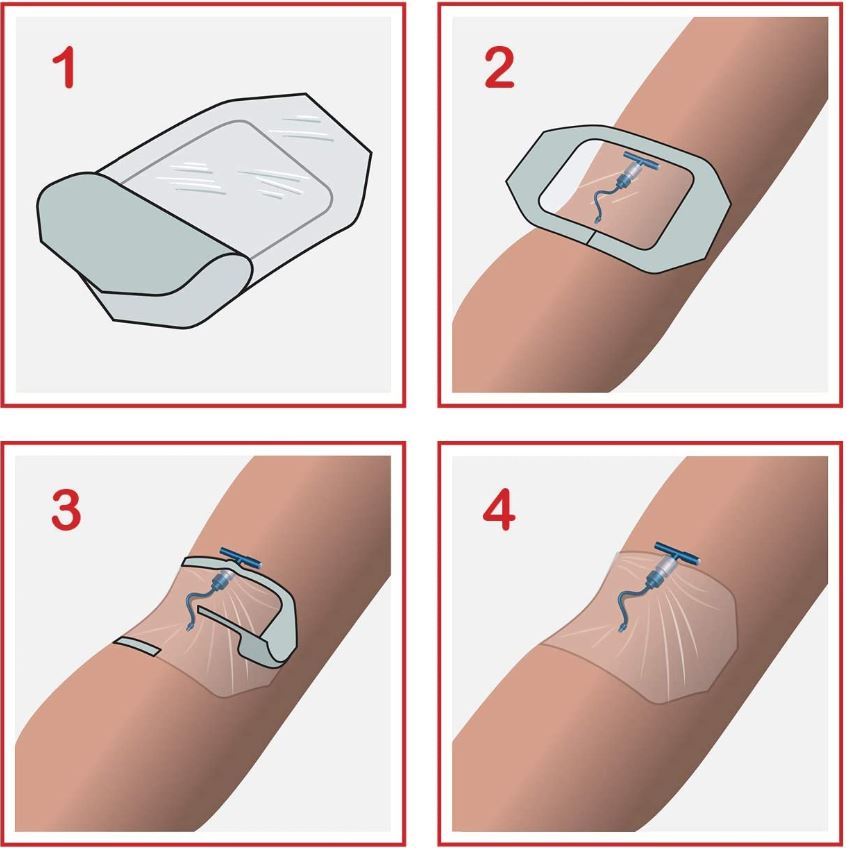 FILM DRESSING, semi-permeable, adhesive, IV, sterile, M