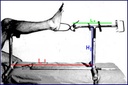 CADRE DE TRACTION ORTHOPEDIQUE TRILLAT, inox, L 65 à 90 cm