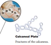 PLAQUE à CALCANEUM, 70 mm