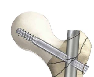 VIS CERVICALE, inox, Ø 10.5 x 95 mm, stérile